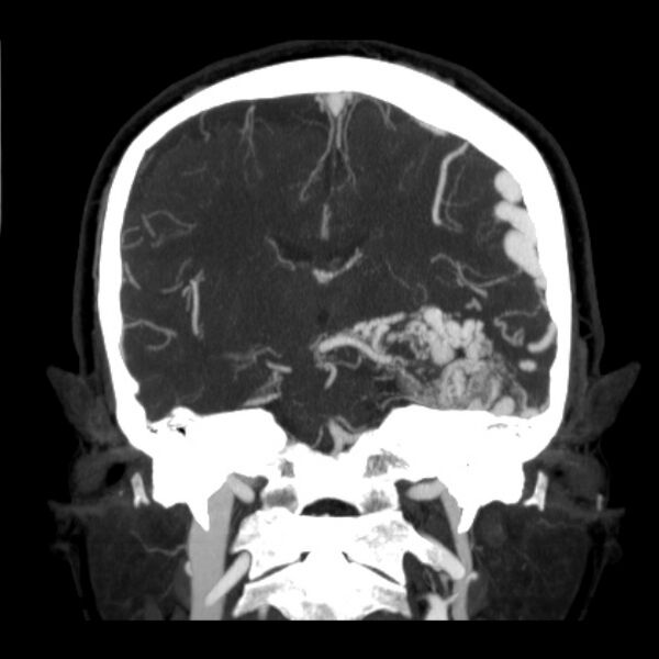File:Cerebral arteriovenous malformation (Radiopaedia 43729-47189 C 25).jpg