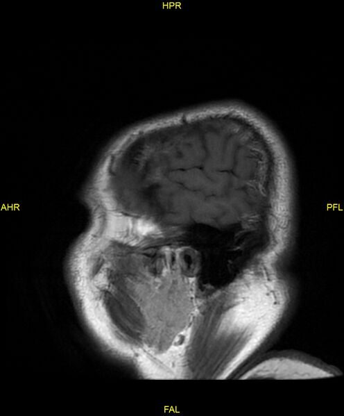 File:Cerebral autosomal dominant arteriopathy with subcortical infarcts and leukoencephalopathy (CADASIL) (Radiopaedia 86108-102054 Sagittal T1 3).jpg