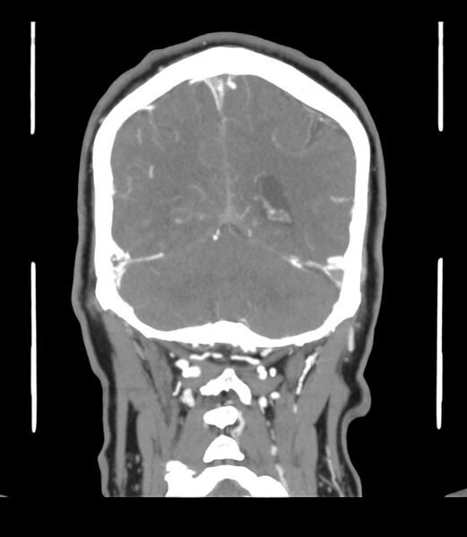 File:Cerebral dural venous sinus thrombosis (Radiopaedia 86514-102576 B 57).jpg
