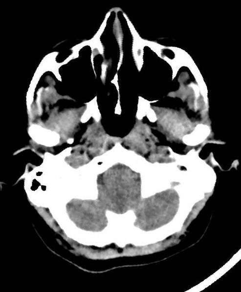 File:Cerebral edema due to severe hyponatremia (Radiopaedia 89826-106937 Axial non-contrast 11).jpg