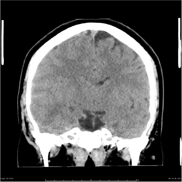 File:Cerebral hemorrhage secondary to arteriovenous malformation (Radiopaedia 33497-34561 Coronal non-contrast 23).jpg