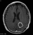 Cerebral radiation necrosis (Radiopaedia 5665-7376 Axial T1 C+ 1).jpg