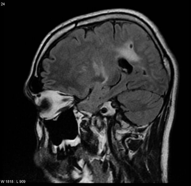 File:Cerebral vasculitis (Radiopaedia 5131-6923 Sagittal FLAIR 8).jpg
