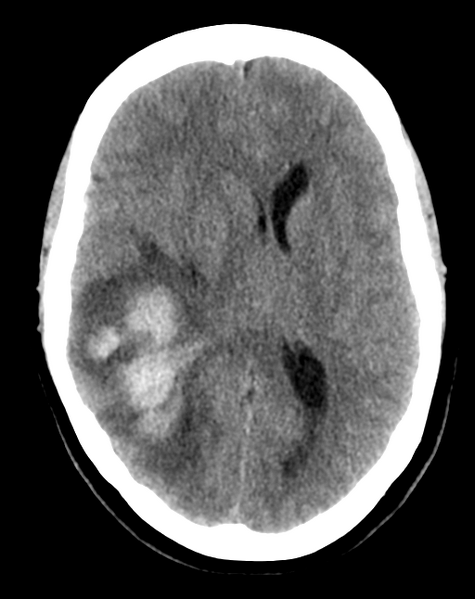 File:Cerebral venous infarct related to dural venous sinus thromboses (Radiopaedia 35292-36803 AXIAL THICK 15).png