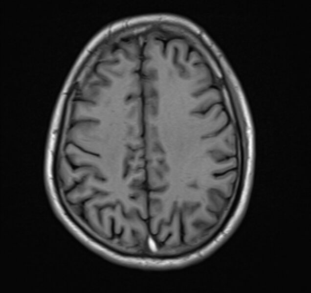 File:Cerebral venous thrombosis (Radiopaedia 71207-81504 Axial T1 18).jpg