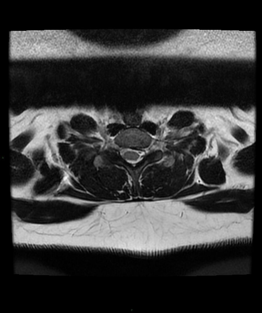 Cervical disc prolapse (Radiopaedia 80258-93598 Axial T2 68).jpg