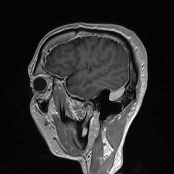 File:Cervical dural CSF leak on MRI and CT treated by blood patch (Radiopaedia 49748-54995 G 8).jpg