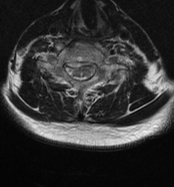 File:Cervical spondylodiscitis (Radiopaedia 81362-95110 Axial T2 13).jpg