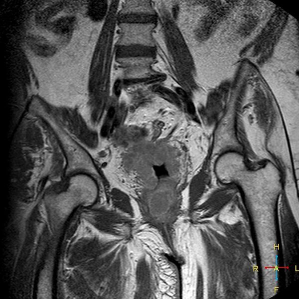 File:Cervical stump squamous cell carcinoma (Radiopaedia 48049-52858 Coronal T1 C+ 8).jpg