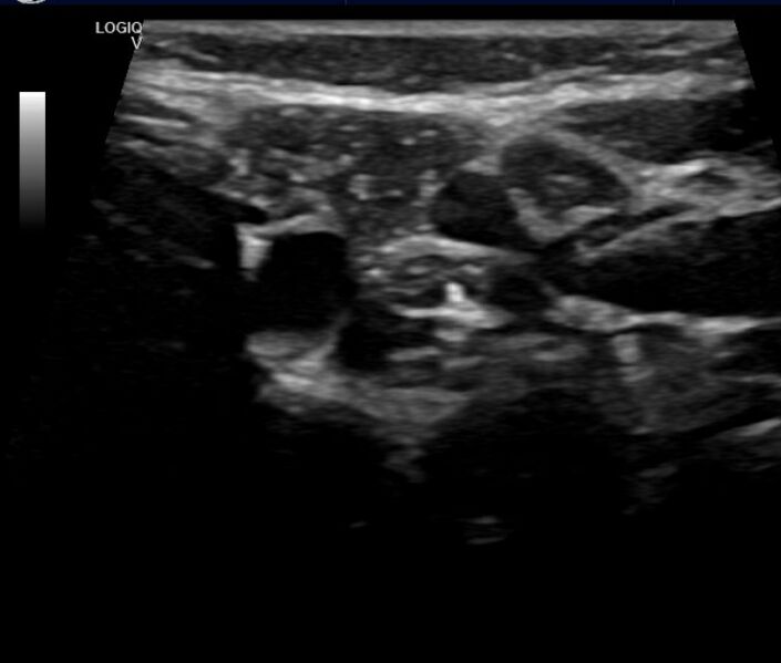 File:Cervical thymus (Radiopaedia 66589-75878 D 1).jpg