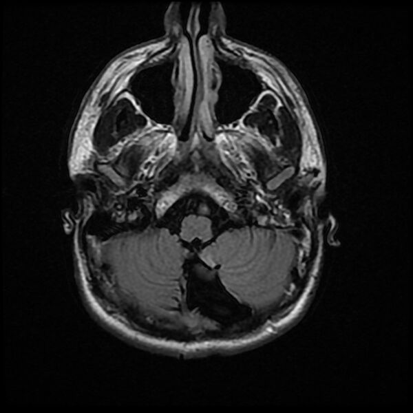 File:Chiasmatic-hypothalamic juvenile pilocytic astrocytoma (Radiopaedia 78533-91235 Axial FLAIR 6).jpg