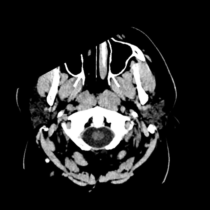 Chiasmatic-hypothalamic juvenile pilocytic astrocytoma (Radiopaedia 78533-91237 Axial non-contrast 5).jpg