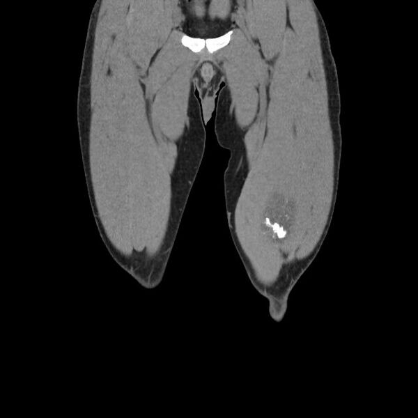 File:Chondrosarcoma arising from exostosis (Radiopaedia 59996-67507 Coronal soft tissue 2).jpg