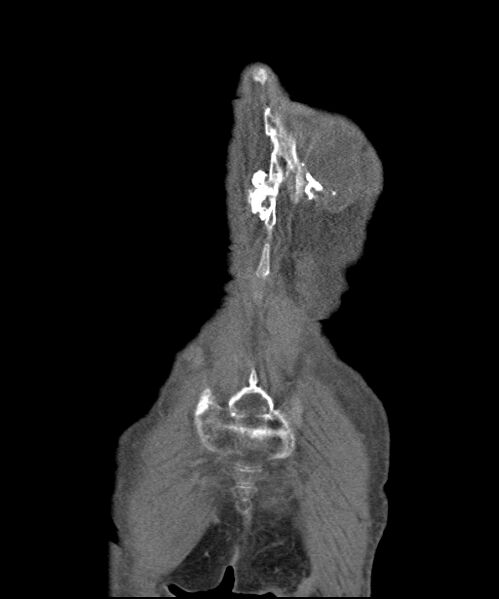 File:Chondrosarcoma of the spine (Radiopaedia 49871-55143 B 2).jpg