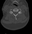 Chordoma (C4 vertebra) (Radiopaedia 47561-52188 Axial bone window 29).png