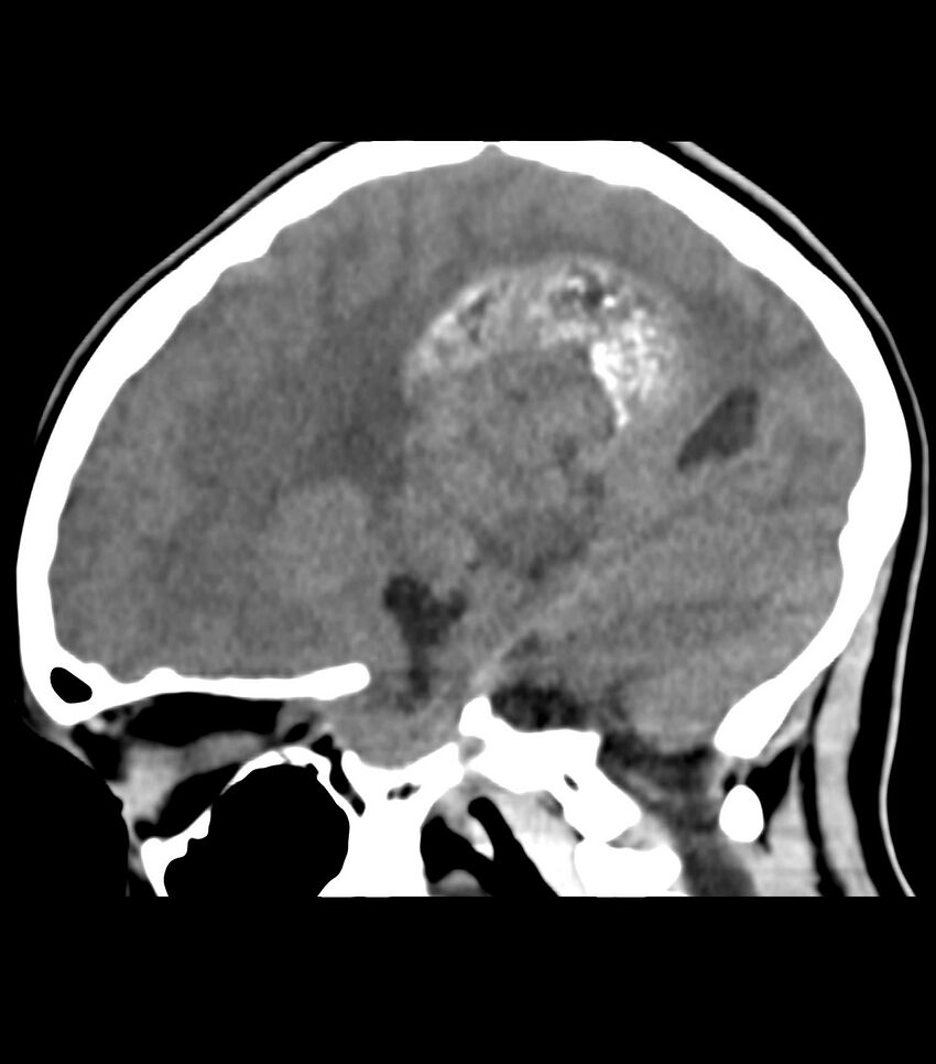 Choroid plexus carcinoma (Radiopaedia 91013-108552 B 45).jpg