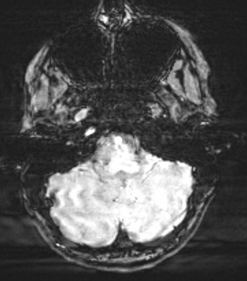 Choroid plexus carcinoma (Radiopaedia 91013-108553 Axial SWI 19).jpg
