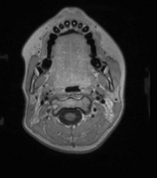 File:Choroid plexus carcinoma (Radiopaedia 91013-108553 Axial T1 C+ 45).jpg