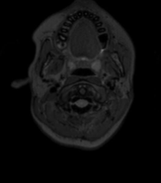 File:Choroid plexus carcinoma (Radiopaedia 91013-108553 Axial T2 fat sat 18).jpg