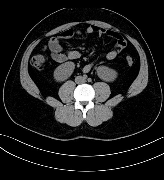 File:Chromophobe renal cell carcinoma (Radiopaedia 84286-99573 Axial non-contrast 32).jpg