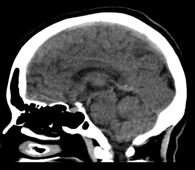 File:Chronic bilateral occipital lobe infarcts (Radiopaedia 31276-31996 C 20).jpg