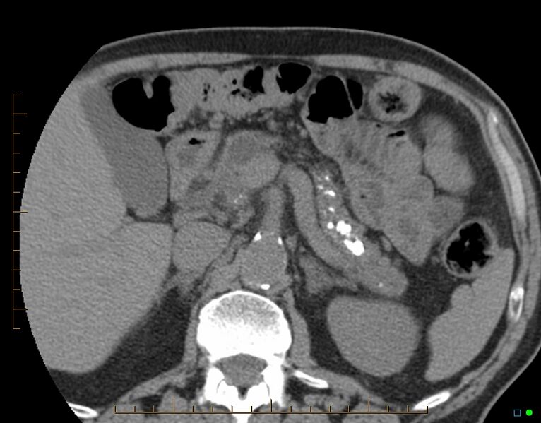 File:Chronic pancreatitis (Radiopaedia 17014-16717 B 1).jpg
