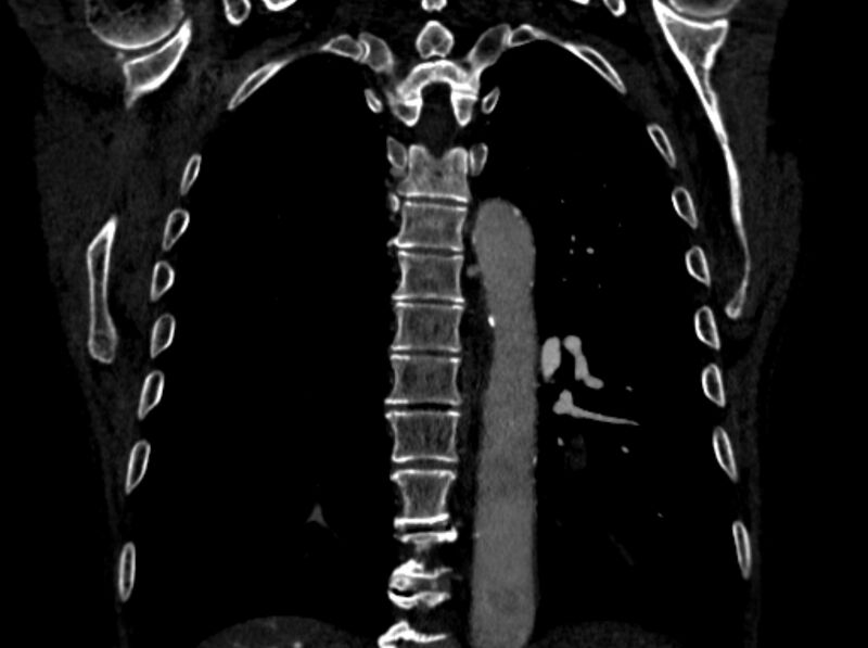 File:Chronic pulmonary embolism (Radiopaedia 91241-108843 A 79).jpg
