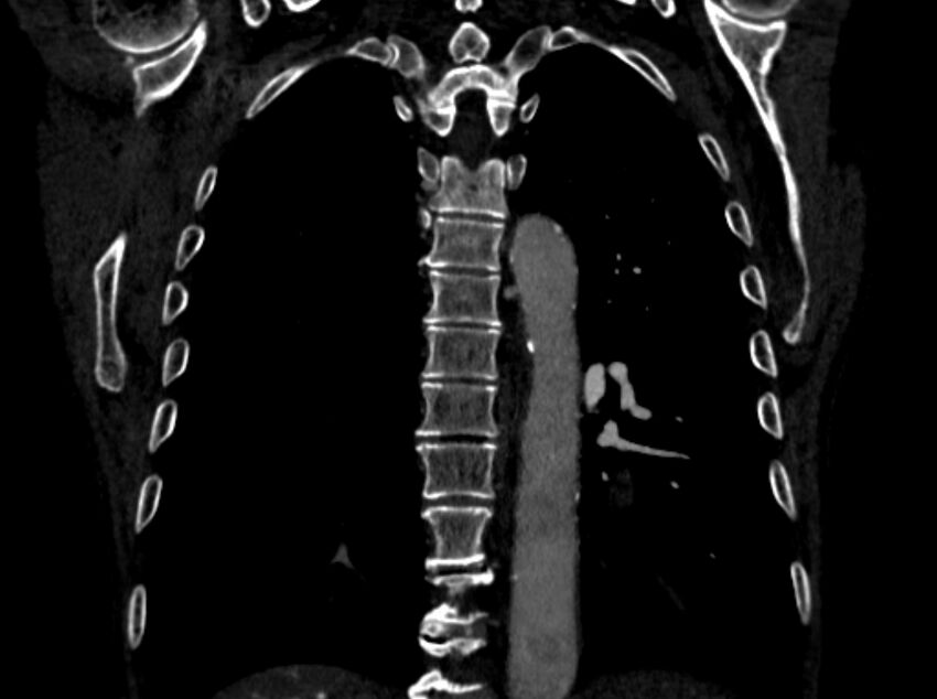 Chronic pulmonary embolism (Radiopaedia 91241-108843 A 79).jpg