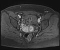 Class II Mullerian duct anomaly- unicornuate uterus with rudimentary horn and non-communicating cavity (Radiopaedia 39441-41755 Axial T1 fat sat 76).jpg