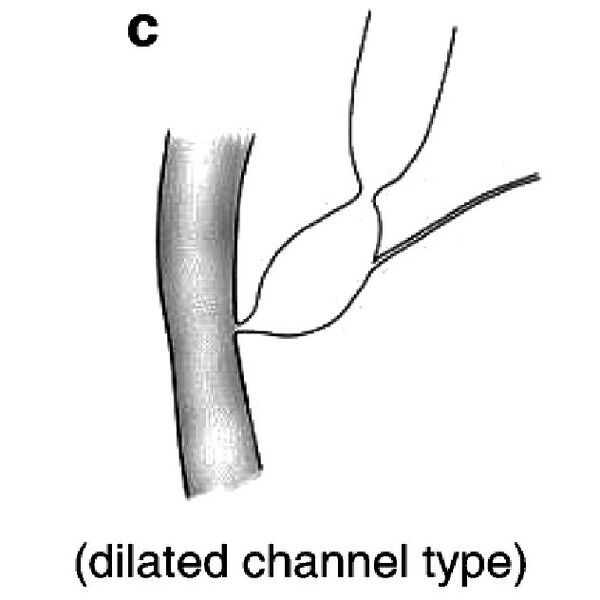 File:Classification of pancreaticobiliary maljunction (diagram) (Radiopaedia 75203-86297 C 1).jpg