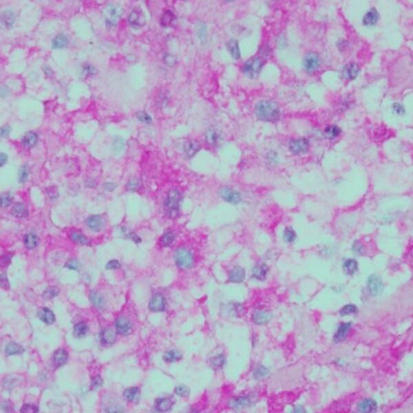 File:Clear cell meningoma - lumbar spine (Radiopaedia 60116-78655 PAS 1).jpg