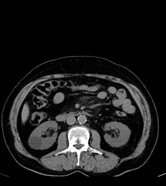 File:Clear cell renal cell carcinoma (Radiopaedia 85006-100539 Axial non-contrast 41).jpg