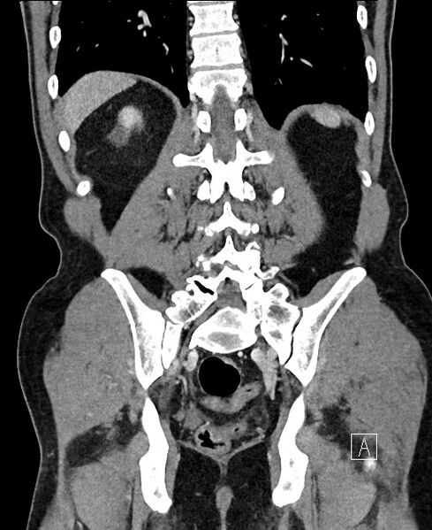 File:Closed loop small bowel obstruction - internal hernia (Radiopaedia 57806-64778 A 91).jpg