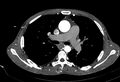 Coarctation of aorta with aortic valve stenosis (Radiopaedia 70463-80574 A 73).jpg