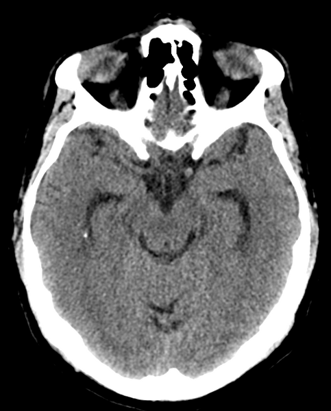File:Colloid cyst of the third ventricle (Radiopaedia 86571-102661 Axial non-contrast 14).png