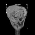 Colocolic fistula - Crohn disease (Radiopaedia 57063-63955 B 11).jpg