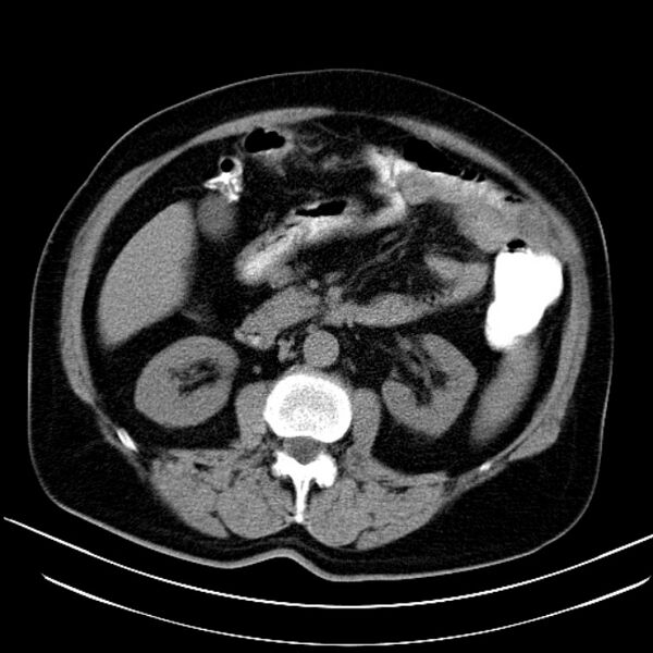 File:Colon adenocarcinoma (Radiopaedia 15157-15025 Axial non-contrast 5).jpg