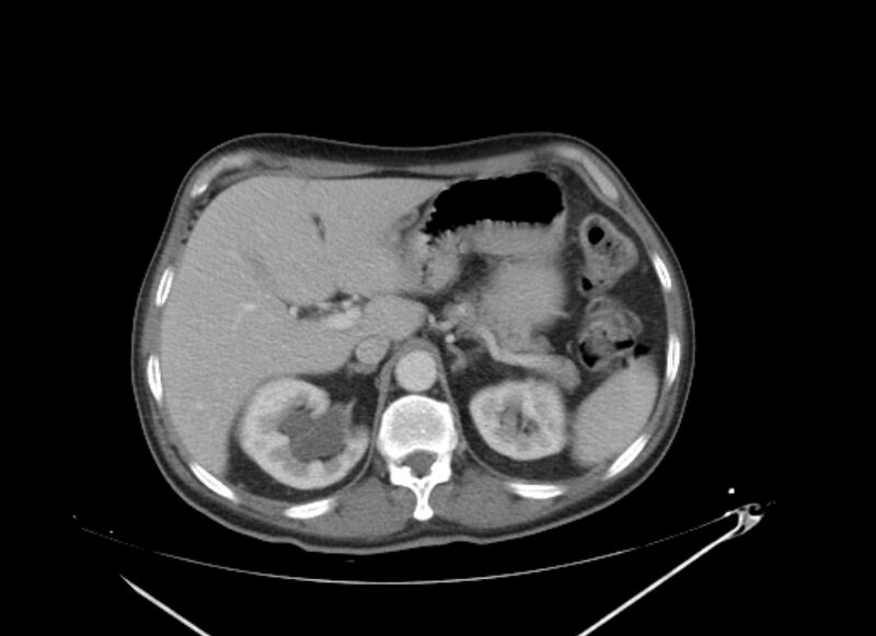 File:Colon cancer mimicking renal cell carcinoma (Radiopaedia 28986-29335 C 19).jpg