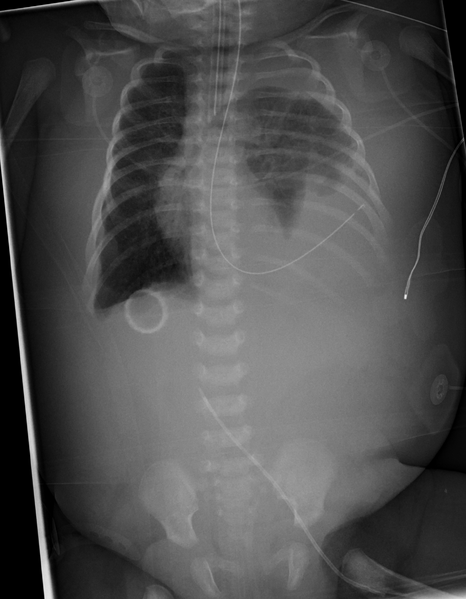 File:Congenital diaphragmatic hernia (Radiopaedia 41985).PNG