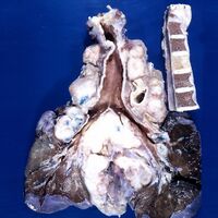 Hodgkin lymphoma (gross pathology)