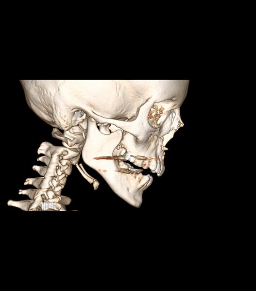 File:Nasoorbitoethmoid fracture (Radiopaedia 90044-107205 3D VRT 2).jpg