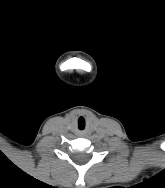 File:Nasoorbitoethmoid fracture (Radiopaedia 90044-107205 Axial non-contrast 15).jpg