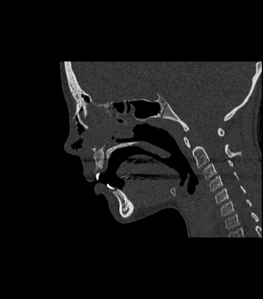 File:Nasoorbitoethmoid fracture (Radiopaedia 90044-107205 Sagittal bone window 78).jpg