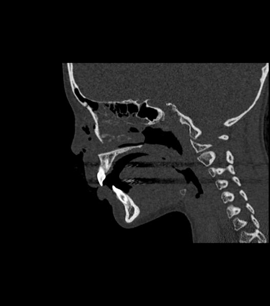 File:Nasoorbitoethmoid fracture (Radiopaedia 90044-107205 Sagittal bone window 83).jpg