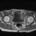 Necrotizing epididymo-orchitis with intra-testicular abscess (Radiopaedia 29397-29860 Axial T1 2).jpg