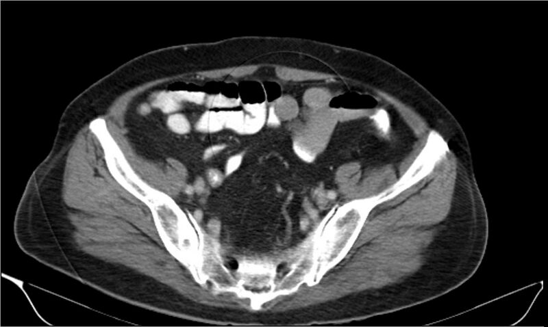 File:Necrotizing pancreatitis (Radiopaedia 20595-20495 A 36).jpg