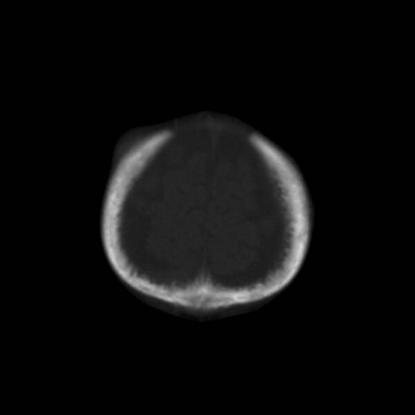 File:Neuroblastoma with skull metastases (Radiopaedia 30326-30958 Coronal bone window 7).jpg