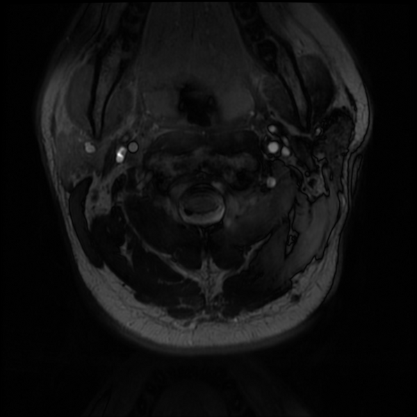 File:Neurofibromatosis type 2 (Radiopaedia 44936-48837 Axial Gradient Echo 41).png