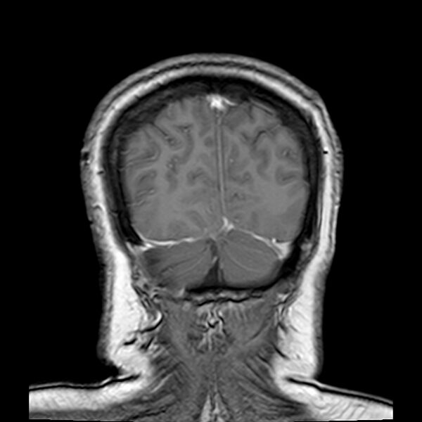 File:Neurofibromatosis type 2 (Radiopaedia 67470-76871 Coronal T1 C+ 21).jpg