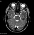 Neurosarcoidosis (Radiopaedia 10930-17204 Axial T2 6).jpg